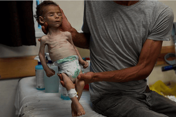 An Israeli-imposed famine has resulted in starvation deaths of many civilians, including children, in the Gaza Strip.
