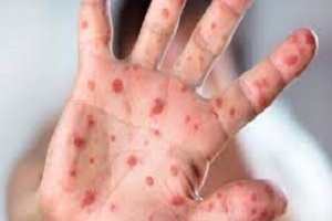 شیوع سرخک در قزوین شیوع سرخک در قزوین
