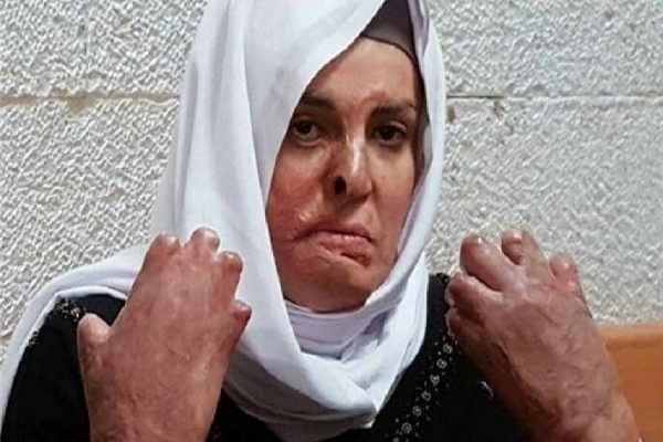 اسراء جعابیص، اسیر زن فلسطینی با سوختگی 60 درصد
