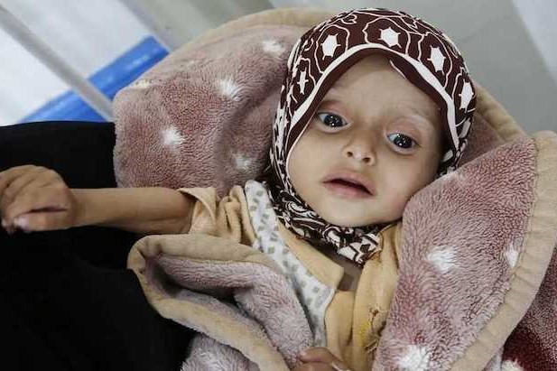 Yemen, il 75% dei bambini è cronicamente malnutrito Yemen, il 75% dei bambini è cronicamente malnutrito