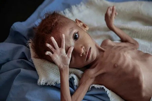 سازمان‌ ملل: یمن در آستانه فاجعه عظیمی قرار دارد
