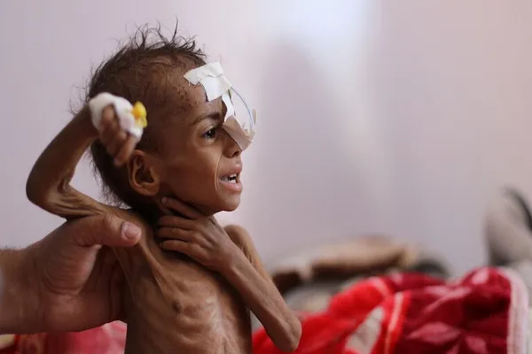 هشدار سازمان ملل درباره قحطی میلیونی در یمن