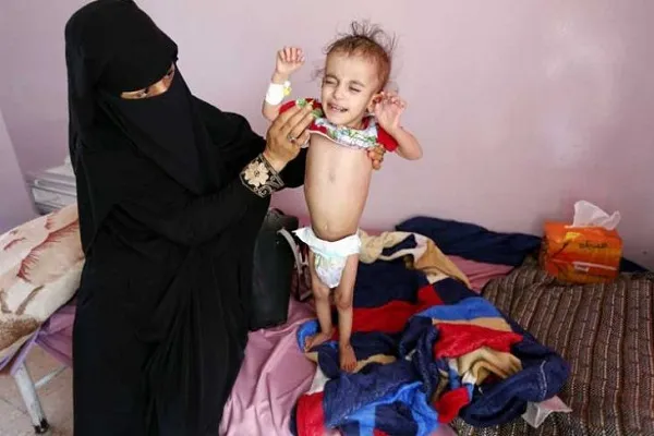 آمار سازمان ملل از موارد مشکوک به وبا در یمن