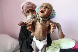 Half of Yemen Population on Brink of Famine as Saudi-Led Aggression Continues