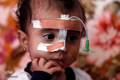 سوءتغذیه کودکان «یمنی» را می کشد