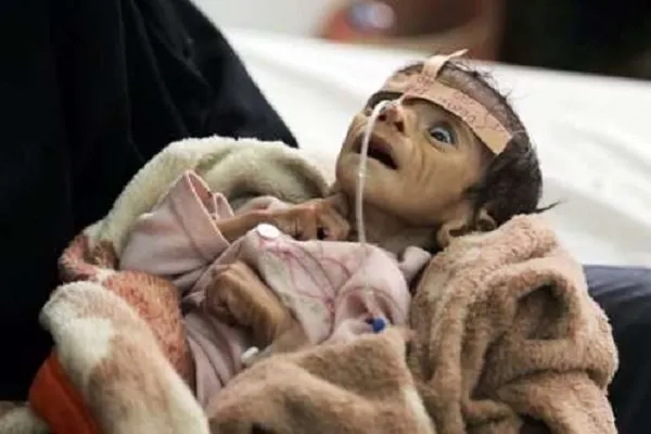 سازمان ملل: هر 5 ثانیه یک کودک از گرسنگی می‌میرد