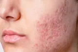 سابسیژن؛ روش تخصصی رفع چاله‌های پوستی و اسکارهای آکنه