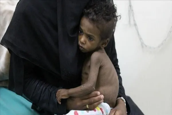 سازمان ملل: 24 میلیون یمنی از سوء تغذیه رنج می‌برند