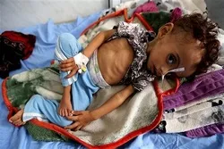Watoto 80,000 wamekufa njaa Yemen tokea Saudia ianzishe hujuma