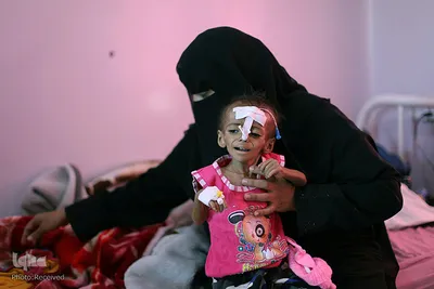 سوءتغذیه کودکان «یمنی» را می کشد