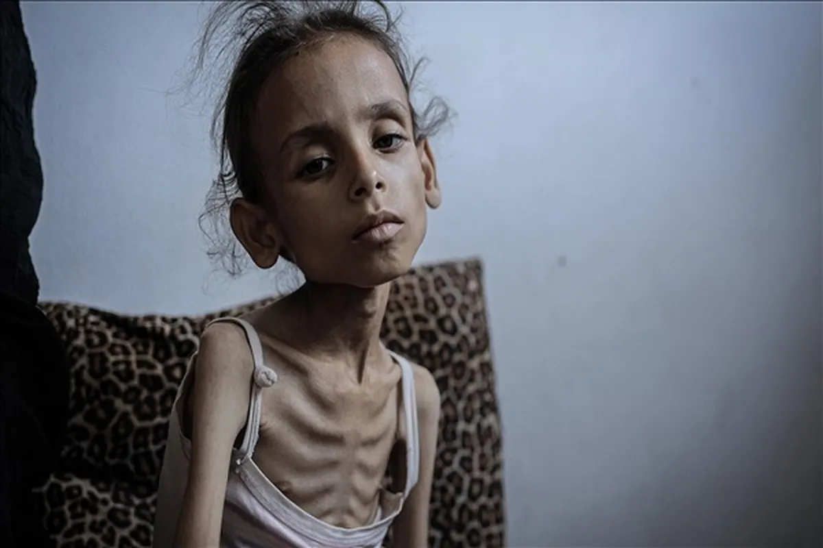Total Deaths of Palestinians Dying from Starvation in Gaza near 170