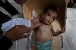 Saudi War on Yemen Causes Deaths of 85,000 Yemeni Kids