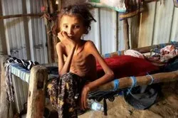 ONU : 400.000 enfants yéménites souffrent de famine