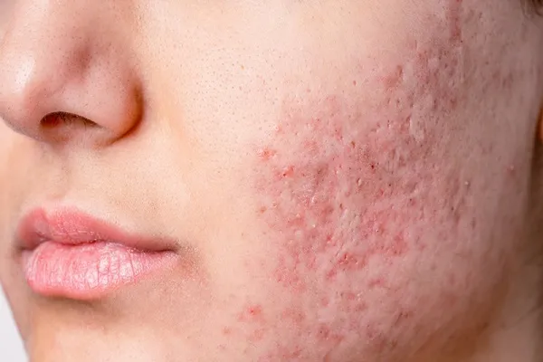 سابسیژن؛ روش تخصصی رفع چاله‌های پوستی و اسکارهای آکنه