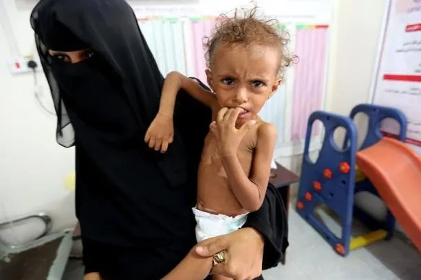 Il bimbo yemenita che conosce solo la fame e non sa cosa sia la pace