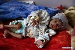 ‘It’s the Worst Place on Earth’: UN Food Agency Chief Says of Yemen  