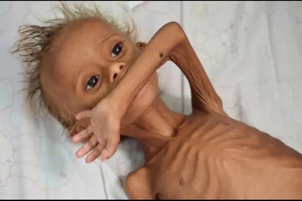 Muere primer niño desnutrido yemení por bloqueo saudí a Al-Hudayda
