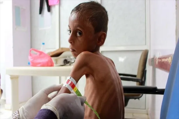 ONU alerta: Más de la mitad de yemeníes sufriría hambre en 2021