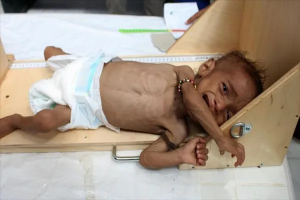 Yemen: Armas prohibidas saudíes causan malformaciones en los bebés