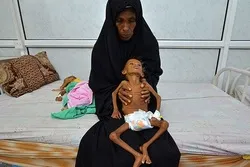 5.4 Million Yemenis Suffering from Malnourishment  