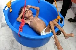 Starving Yemenis Eat Leaves to Survive: Report