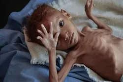 Yemen's Children Suffering from Malnutrition, Lack of Medicine