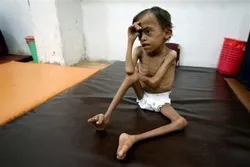 Yemen On Brink of Worst Famine in 100 Years: WFP