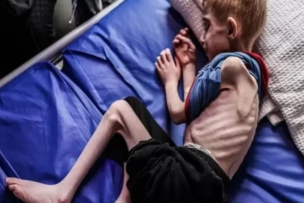 يونيسيف: 50 ألف طفل في غزة يُكابدون سوء التّغذية الحاد